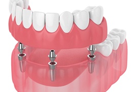 Diagram of implant dentures