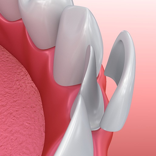 Illustration of veneers being placed on tooth