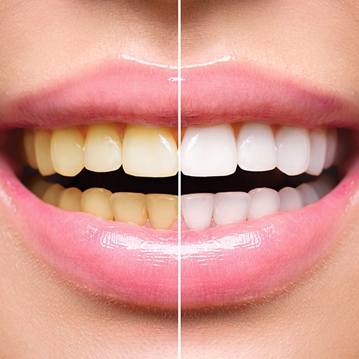 Smile before and after teeth whitening