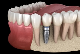 Animated dental implant supported dental crown placement