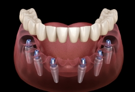 Animated dental implant supported denture